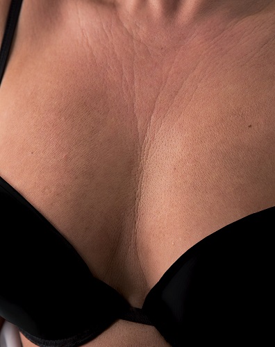 Viscoderm Decolletage - Before